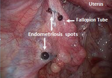 Endometriosis