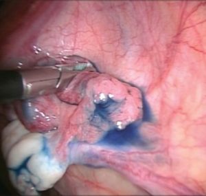 laparoscopy