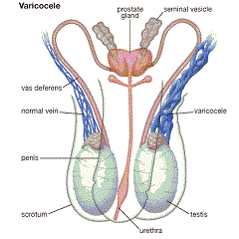 varicocele